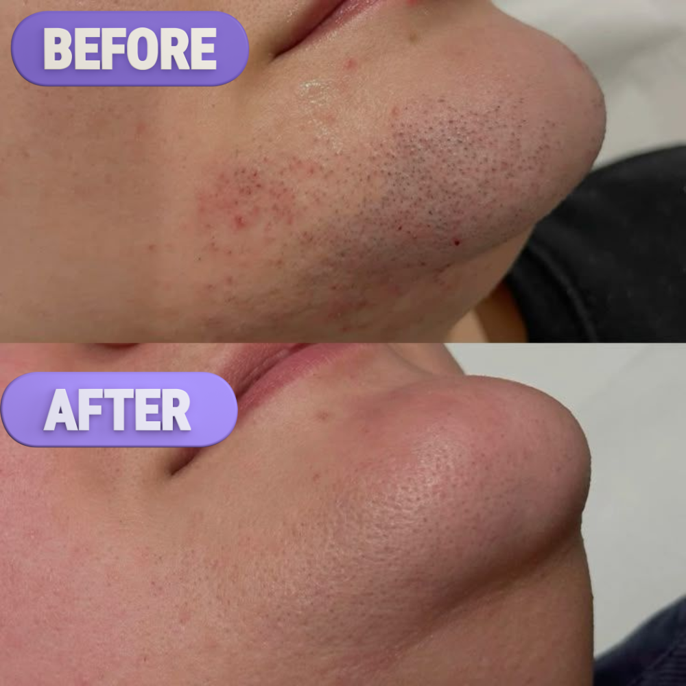 Plux Pro | Gesichtshaar-Entferner